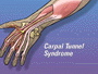 When it comes to treating carpal tunnel syndrome, surgery is often recommended after other therapies have failed.