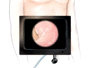 Once in place, the laparoscope will provide video images,