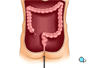 Finally, after a thorough exam, the endoscope is carefully removed.