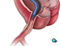 Finally, after a thorough investigation of the region, the catheters and guide wire are withdrawn.