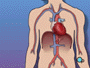 A rare complication of a balloon angioplasty is a stroke. 
<p> But balloon angioplasty is one of the least invasive and least risky of all cardiac procedures. </p>