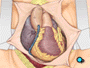 As the temperature and the rhythm of the heart slowly return to normal, the heart-lung machine is disconnected.