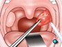 Next, the tonsils are cut free by tightening a wire loop around each of their bases.