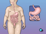 Because of these risks, it's unlikely that your physician would recommend any treatment other than gastric bypass to treat your weight problem. But there are risks associated with surgery as well.