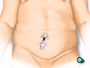 A tube-shaped collar called a trocar will be placed inside the incision to hold it open.