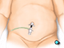 Harmless carbon dioxide gas will be used to inflate the abdomen, serving to enlarge the work area and to separate the organs.