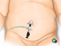 The team then inserts the laparoscope.