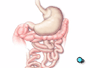 Using these instruments your doctor will then cut the upper portion of the stomach from the rest of the organ