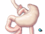 The other end is now attached to the small stomach pouch. A new route for food passing from the esophagus into the intestines has now been created.