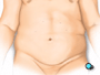 Then the team withdraws all surgical instruments and the incisions are closed with sutures or staples.