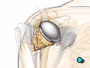 The artificial ball joint is turned inward and fit into the socket... and the team carefully checks to make sure that it fits and allows the full range of normal motion.